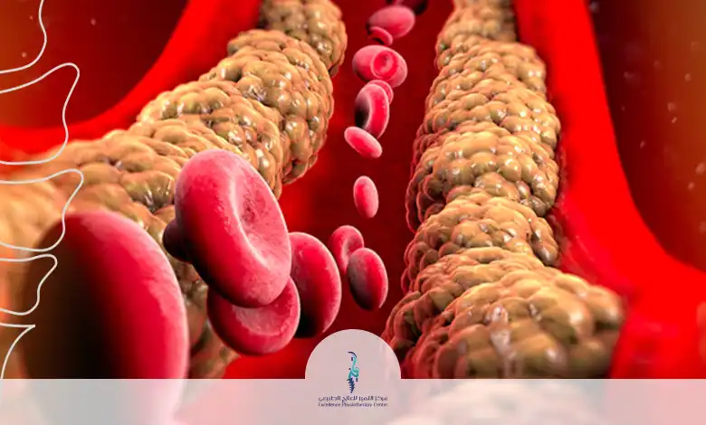 ارتفاع الكولسترول