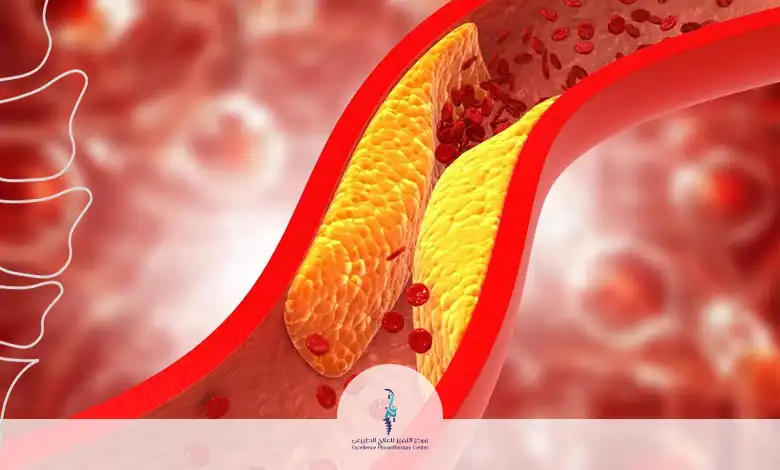 ارتفاع الكولسترول