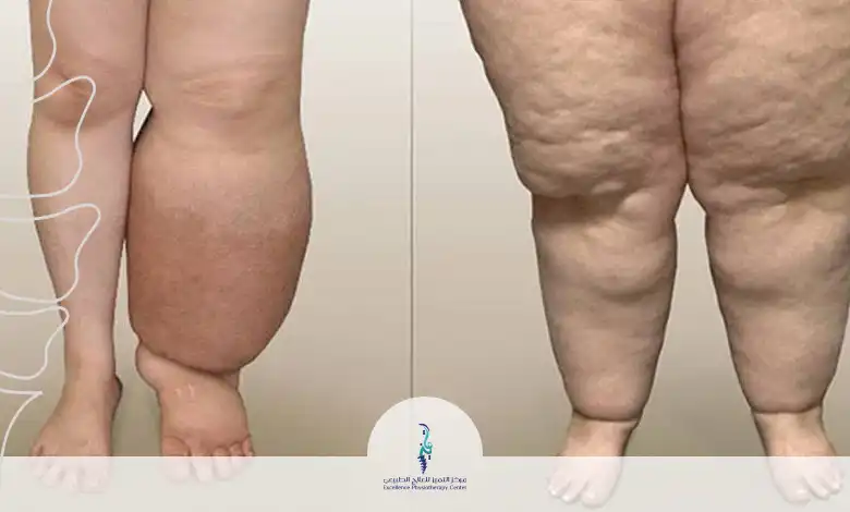 علاج الوذمة اللمفاوية