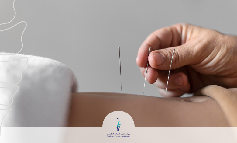 العلاج بالابر الصينية