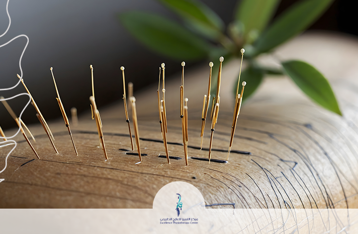 العلاج بالابر الصينية