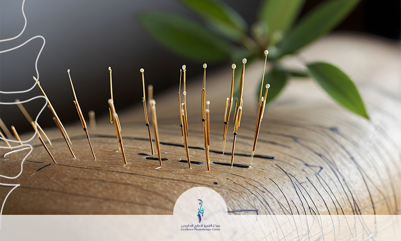 العلاج بالابر الصينية