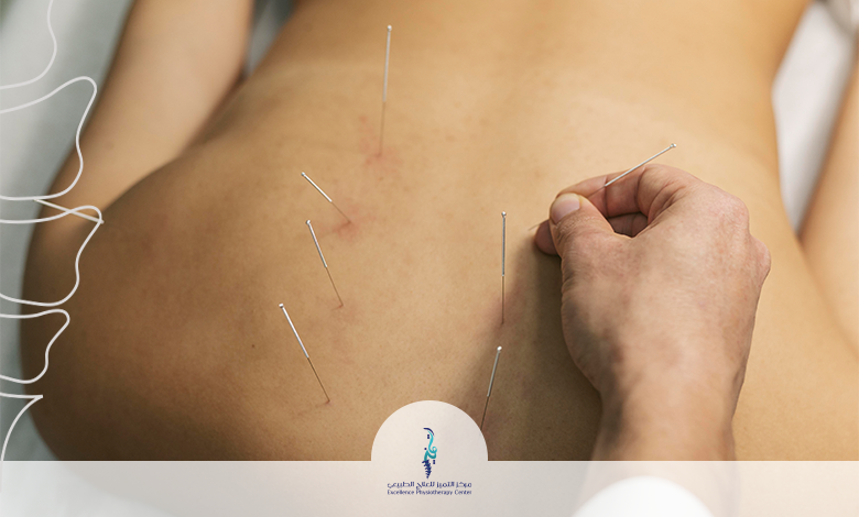 العلاج بالابر الصينية