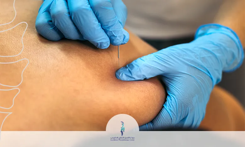 الوخز بالإبر الجافة