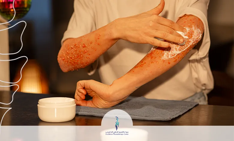  علاج التهاب الأوتار بالأعشاب