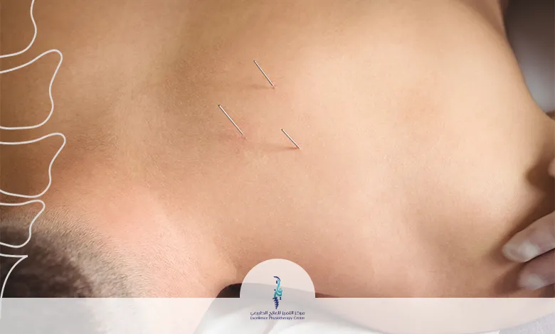 الوخز بالإبر الجافة