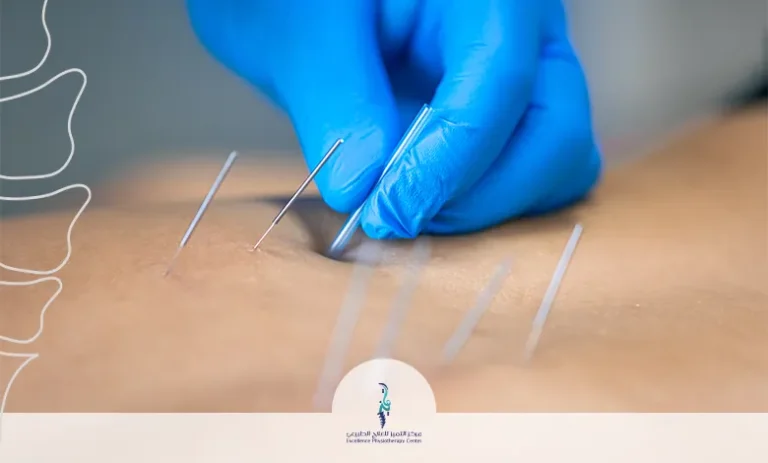 الوخز بالإبر الجافة