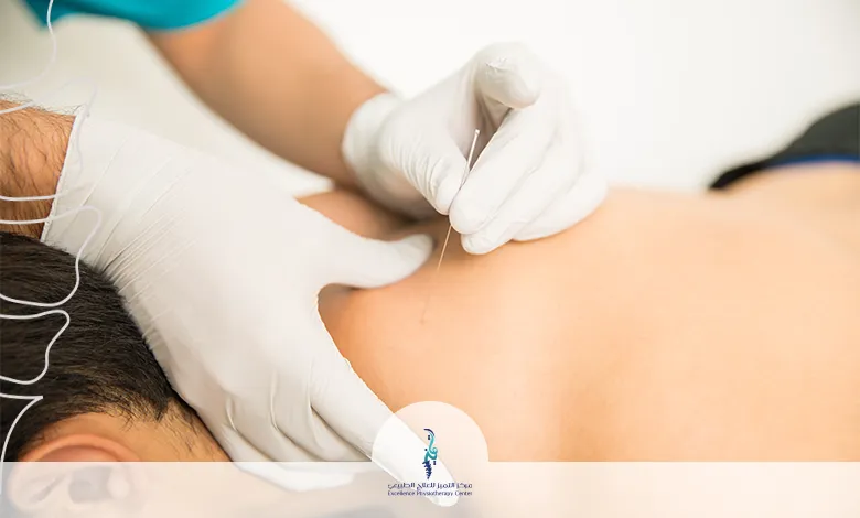 الوخز بالإبر الجافة