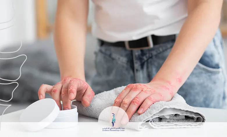  إعادة التأهيل بعد الحروق والجروح