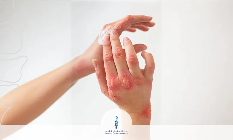 إعادة التأهيل بعد الحروق والجروح 
