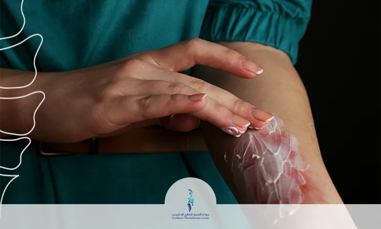 إعادة التأهيل بعد الحروق والجروح