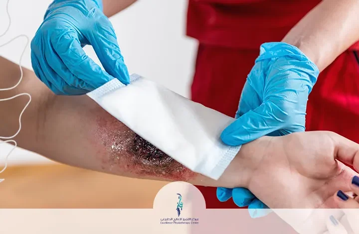 إعادة التأهيل بعد الحروق والجروح