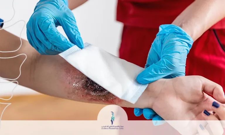 إعادة التأهيل بعد الحروق والجروح