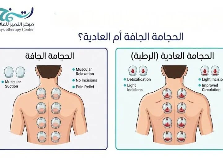 من أفضل الحجامة الجافة أم العادية؟