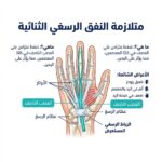 متلازمة النفق الرسغي الثنائية