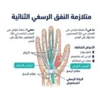 متلازمة النفق الرسغي الثنائية