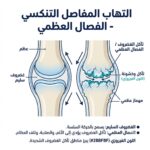 التهاب المفاصل التنكسي الفصال العظمي