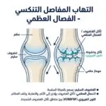 التهاب المفاصل التنكسي الفصال العظمي