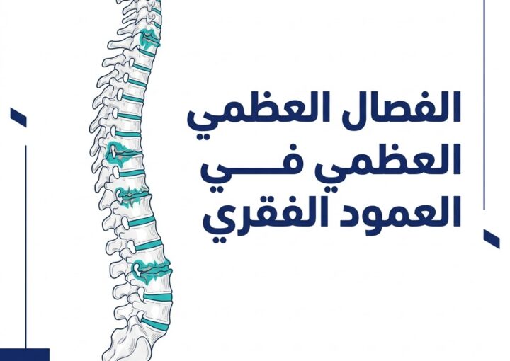الفصال العظمي في العمود الفقري