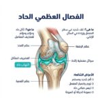 الفصال العظمي الحاد