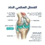 الفصال العظمي الحاد