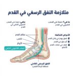 متلازمة النفق الرسغي القدم: الأعراض والأسباب والعلاج الطبيعي