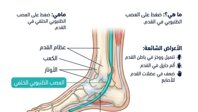 متلازمة النفق الرسغي القدم: الأعراض والأسباب والعلاج الطبيعي