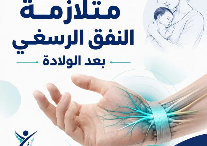 متلازمة النفق الرسغي بعد الولادة