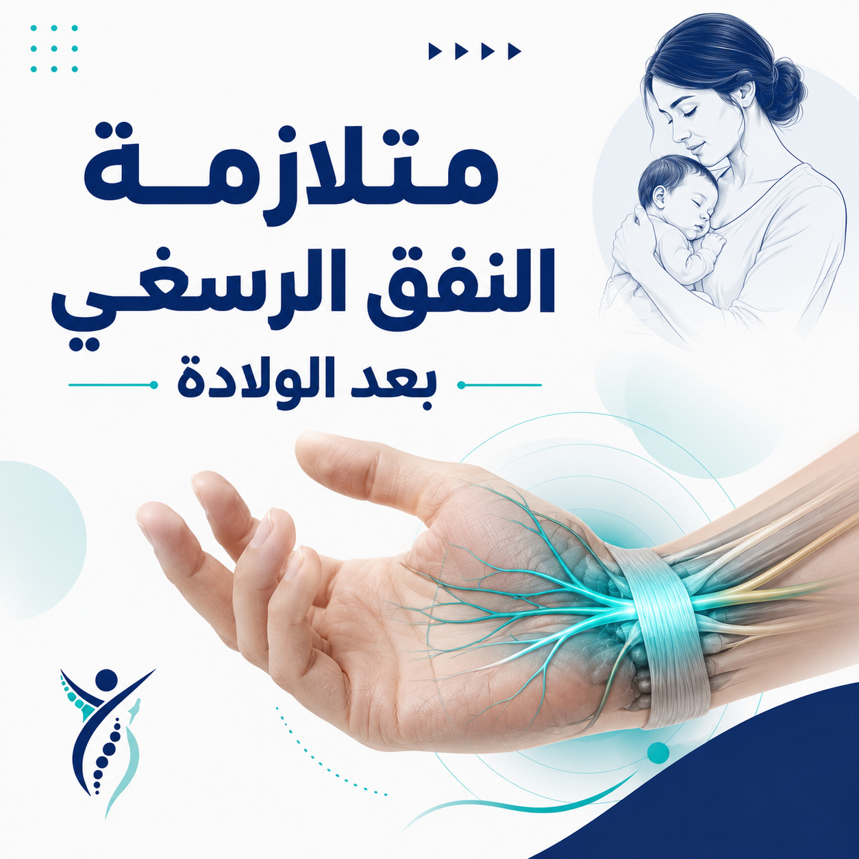متلازمة النفق الرسغي بعد الولادة