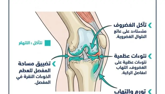 ما هو التهاب مفاصل الركبة؟ الأسباب والأعراض وأفضل طرق العلاج الطبيعي