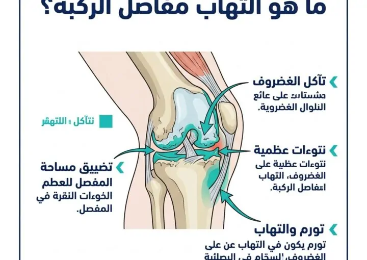ما هو التهاب مفاصل الركبة؟ الأسباب والأعراض وأفضل طرق العلاج الطبيعي