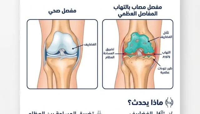 ما هو التهاب المفاصل العظمي؟ دليل شامل للتشخيص والعلاج والوقاية