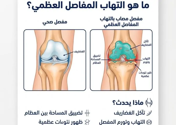 ما هو التهاب المفاصل العظمي؟ دليل شامل للتشخيص والعلاج والوقاية