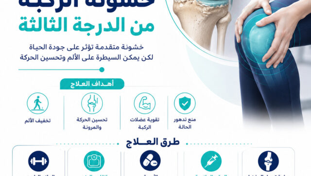 علاج خشونة الركبة من الدرجة الثالثة