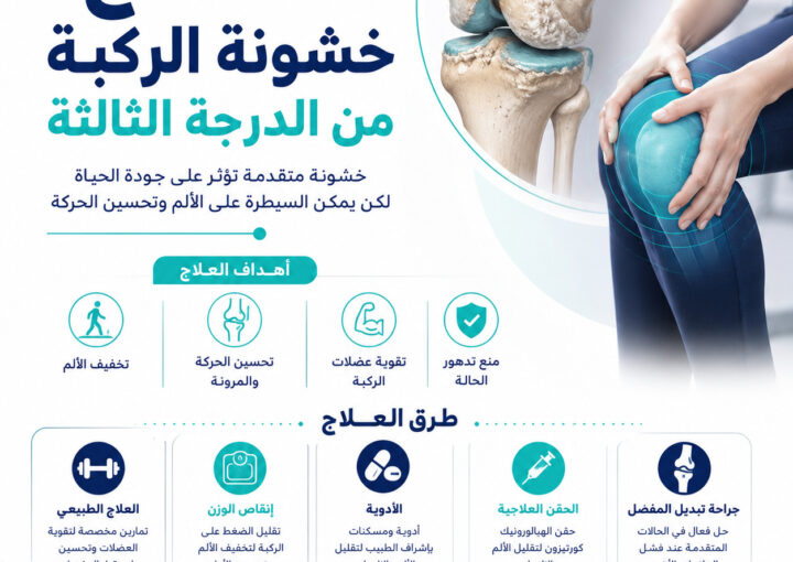 علاج خشونة الركبة من الدرجة الثالثة