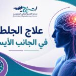 علاج الجلطة في الجانب الأيسر
