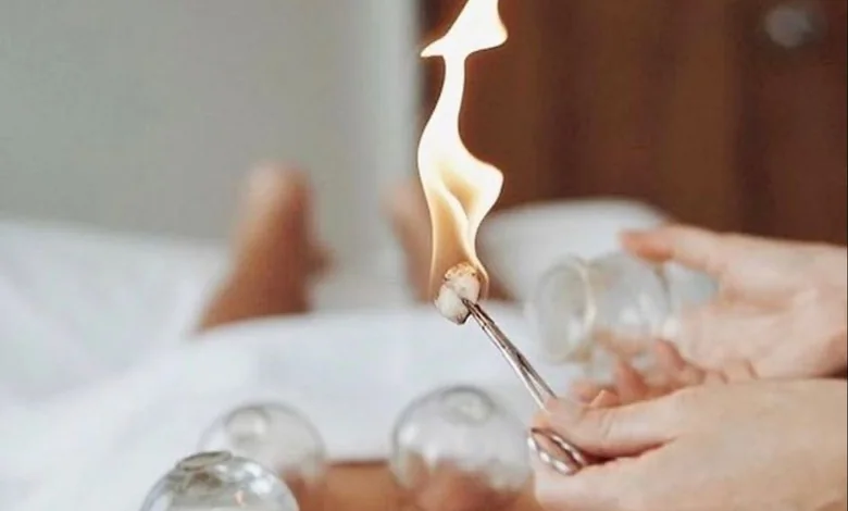 cupping therapy hijama dammam