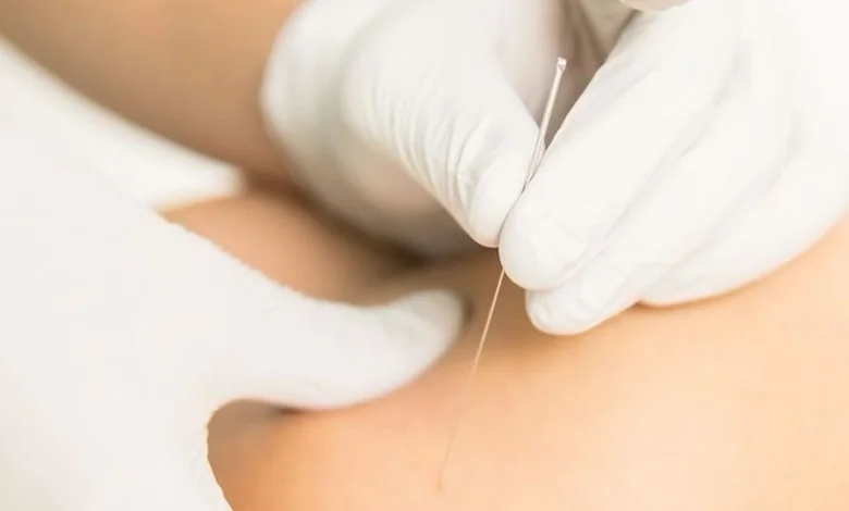 dry needling therapy dammam